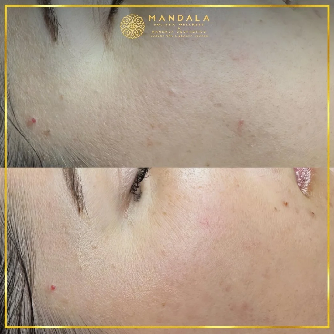 Facial treatment before and after results showing refreshed, hydrated and glowing-looking skin at Mandala Aesthetics in Preston, Melbourne.