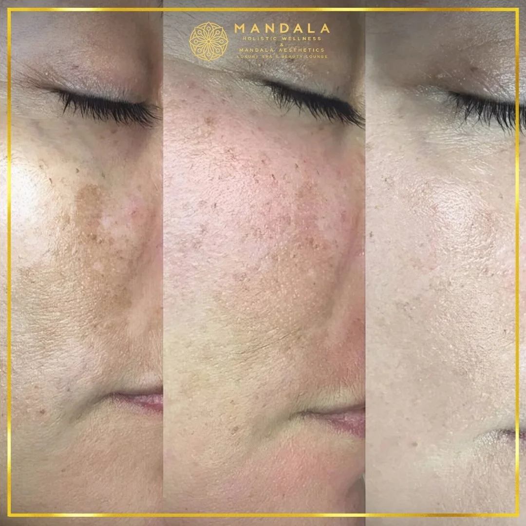 WhiteLab Spot Melanin Removal before and after results showing the appearance of age spots, sun spots , freckles, melasma, pigmentation at Mandala Aesthetics in Preston, Melbourne.