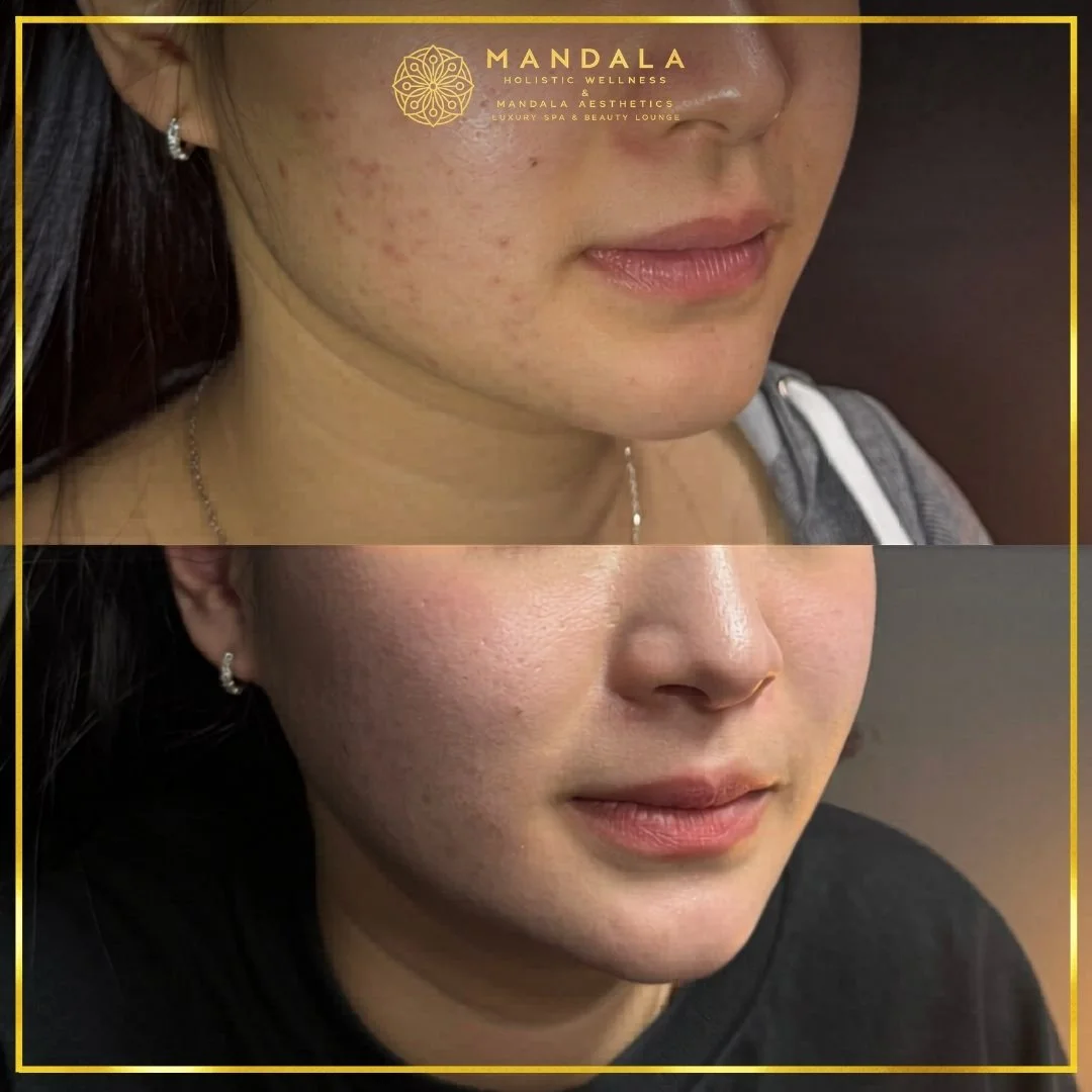 HIFU before and after results showing the lower face, chin and jawline at Mandala Aesthetics in Preston, Melbourne.