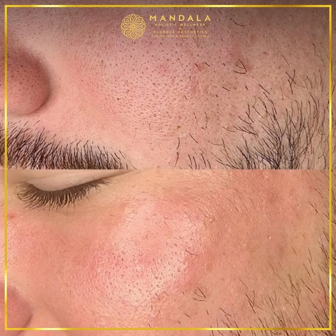 RF Microneedling before and after results showing improved-looking skin texture  and acne scars at Mandala Aesthetics in Preston, Melbourne.