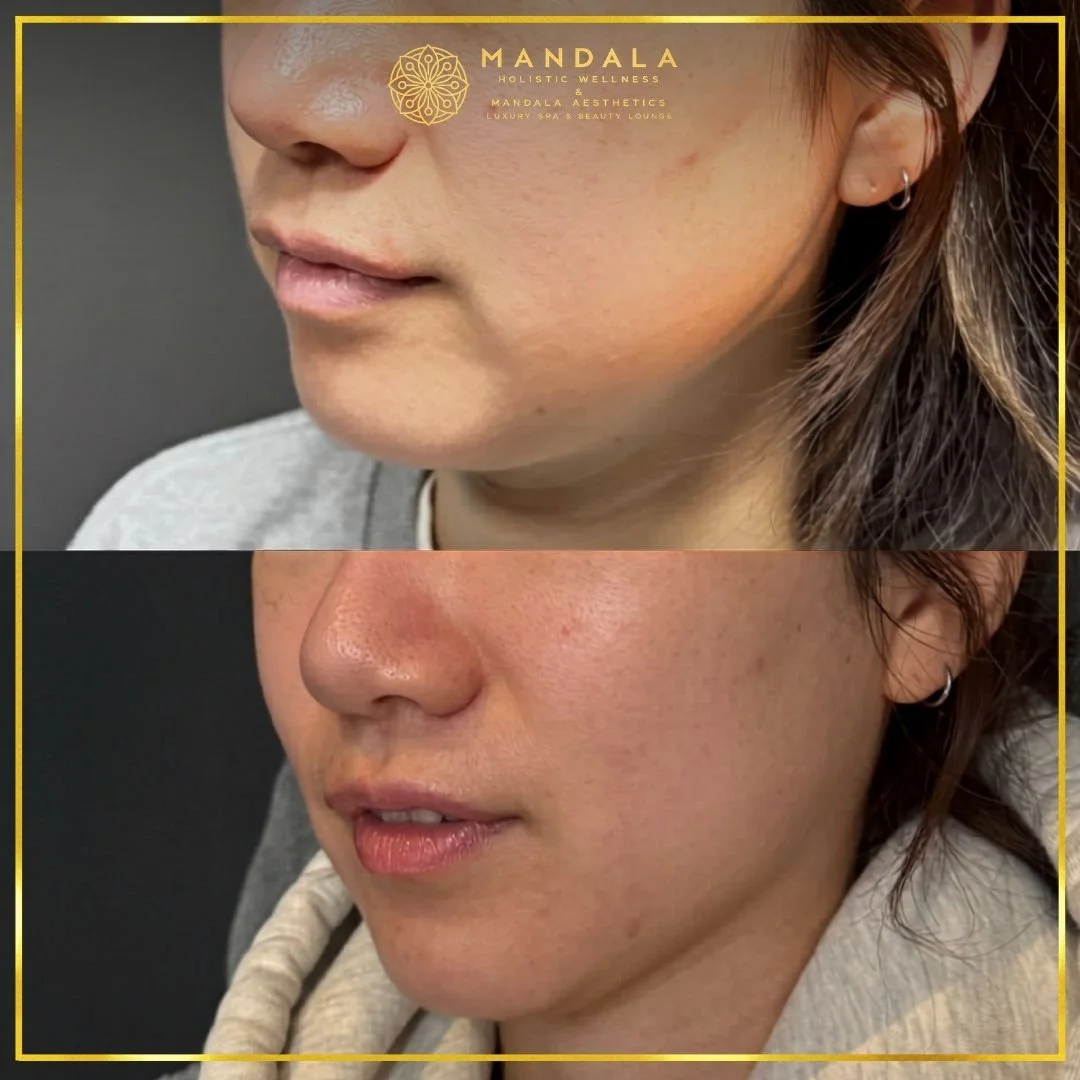 HIFU before and after results showing the lower face, chin and jawline at Mandala Aesthetics in Preston, Melbourne.