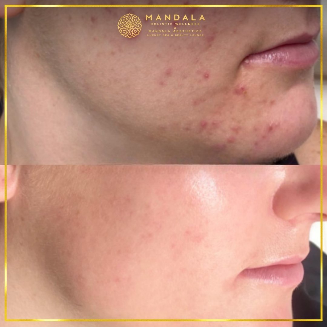 Facial treatment before and after results showing refreshed, hydrated and glowing-looking skin at Mandala Aesthetics in Preston, Melbourne.