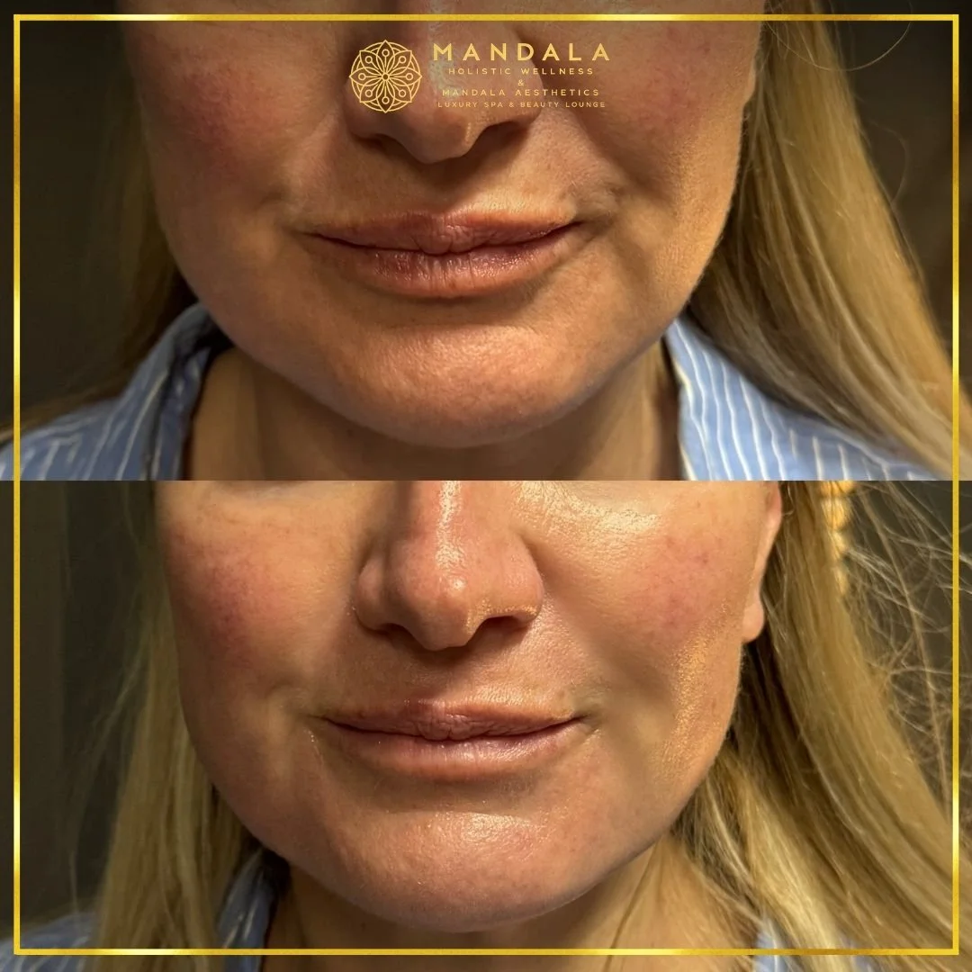 HIFU before and after results showing the lower face, chin and jawline at Mandala Aesthetics in Preston, Melbourne.