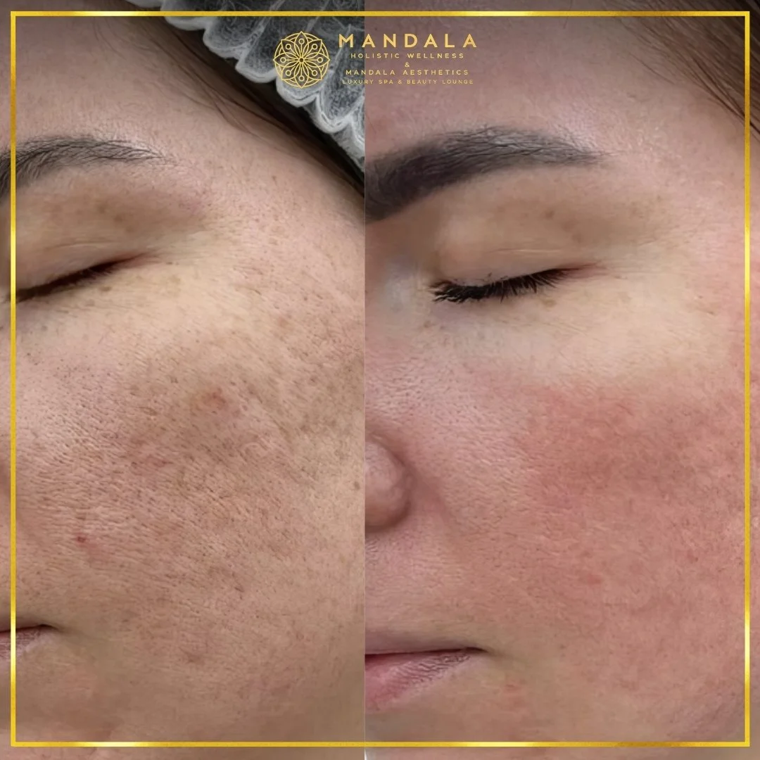 RF Microneedling before and after results showing improved-looking skin texture  and acne scars at Mandala Aesthetics in Preston, Melbourne.