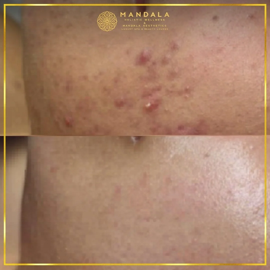 Facial treatment before and after results showing refreshed, hydrated and glowing-looking skin at Mandala Aesthetics in Preston, Melbourne.