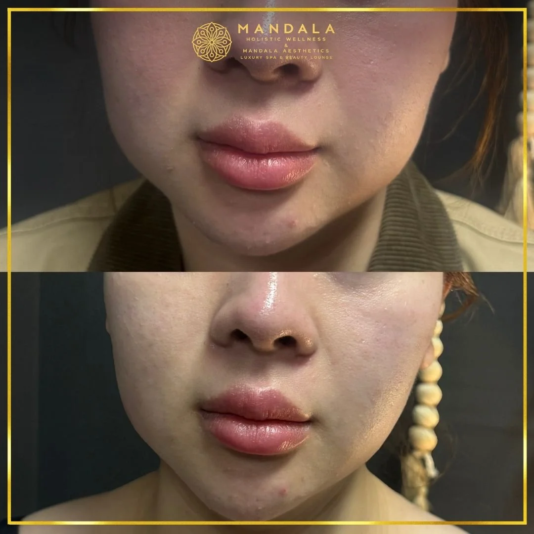 HIFU before and after results showing the lower face, chin and jawline at Mandala Aesthetics in Preston, Melbourne.