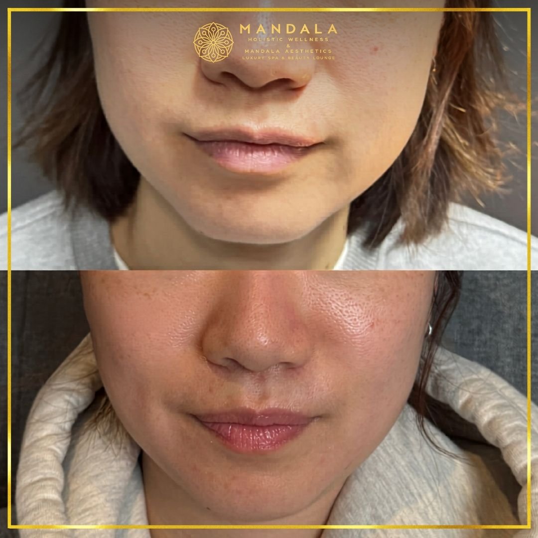 HIFU before and after results showing the lower face, chin and jawline at Mandala Aesthetics in Preston, Melbourne.