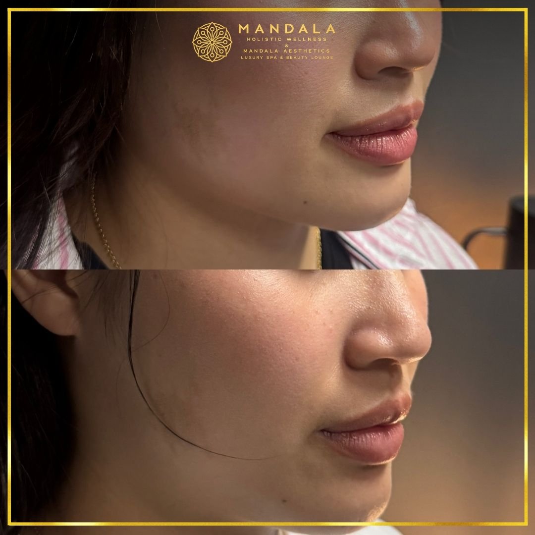 HIFU before and after results showing the lower face, chin and jawline at Mandala Aesthetics in Preston, Melbourne.