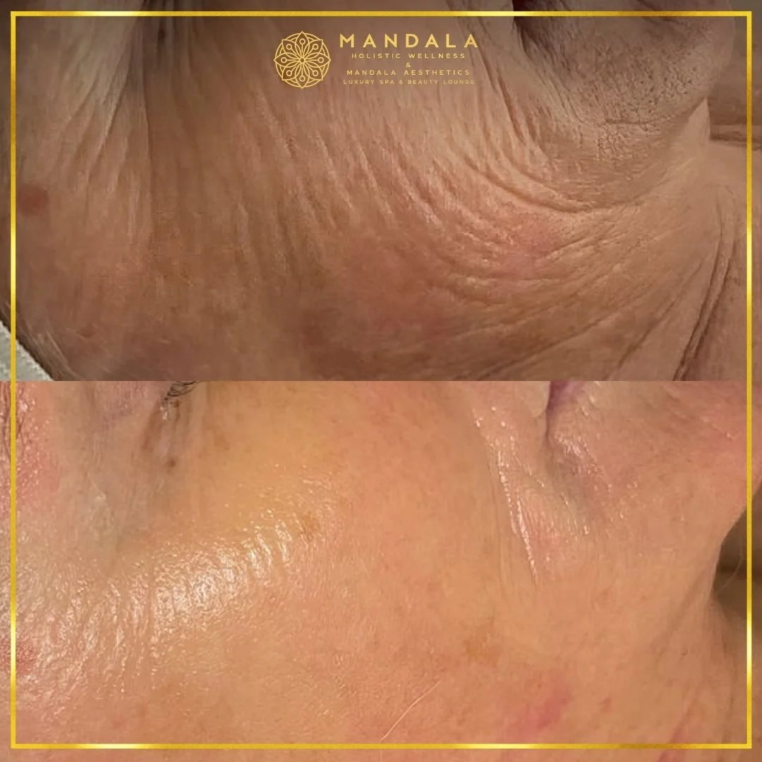 RF Microneedling before and after results showing improved-looking skin texture  and acne scars at Mandala Aesthetics in Preston, Melbourne.