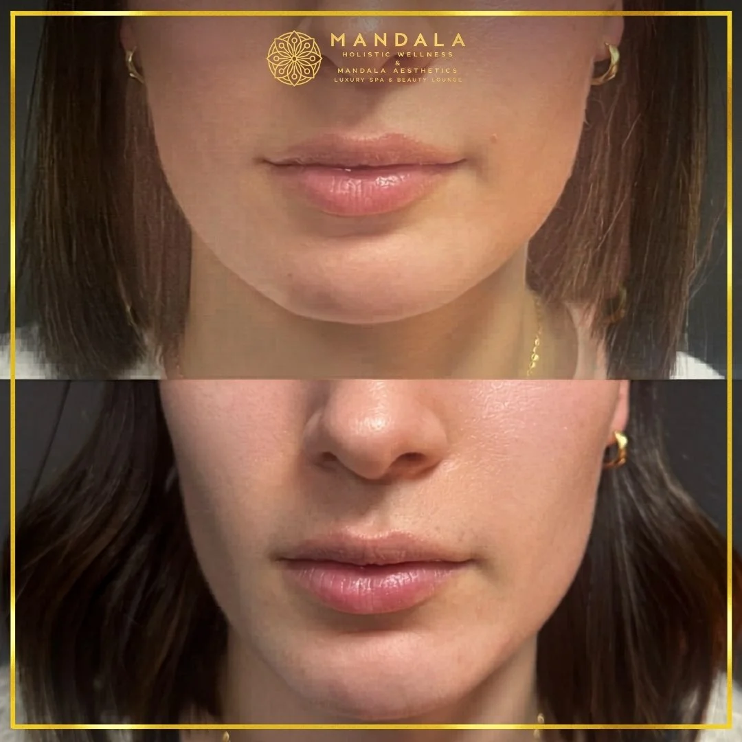 HIFU before and after results showing the lower face, chin and jawline at Mandala Aesthetics in Preston, Melbourne.