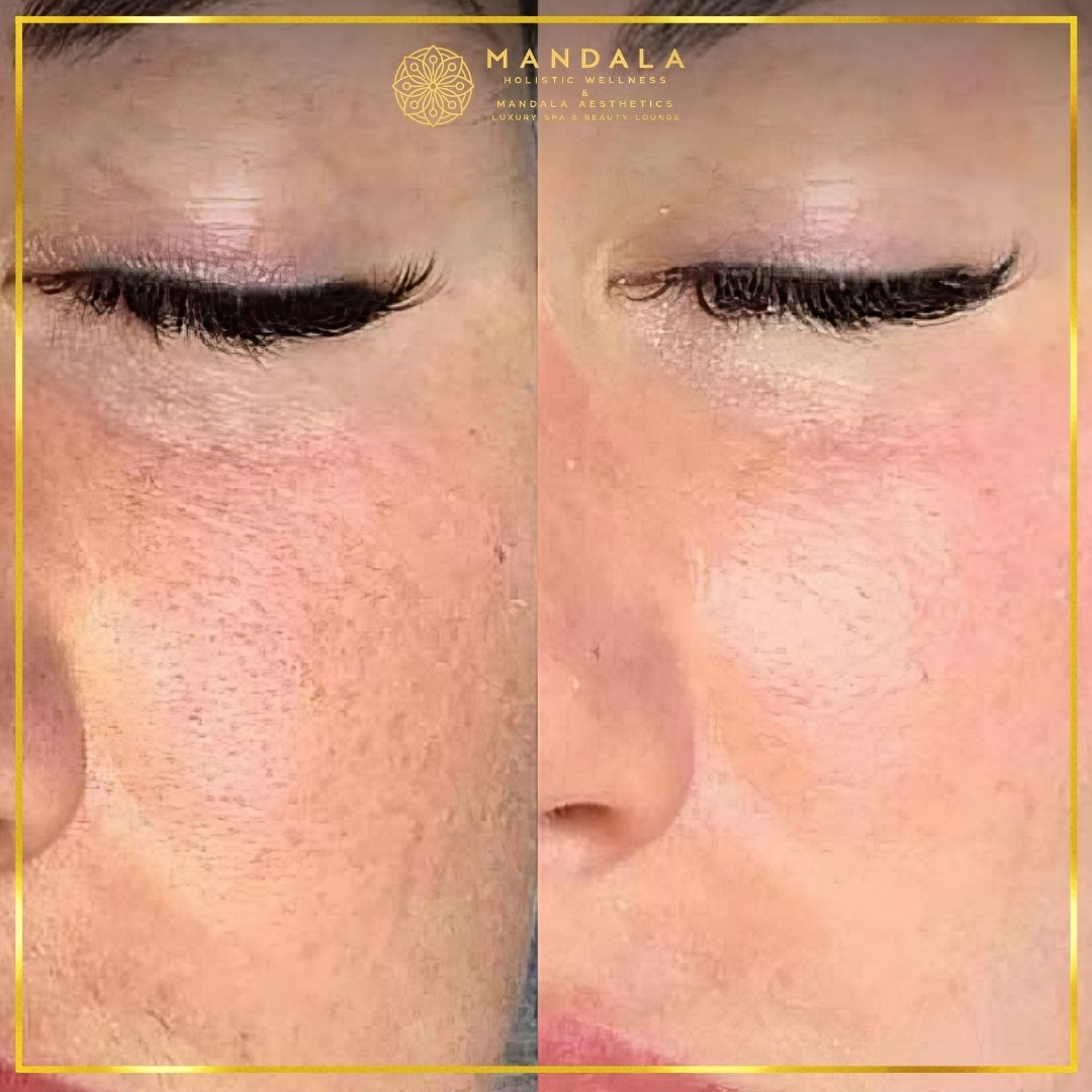 Facial treatment before and after results showing refreshed, hydrated and glowing-looking skin at Mandala Aesthetics in Preston, Melbourne.