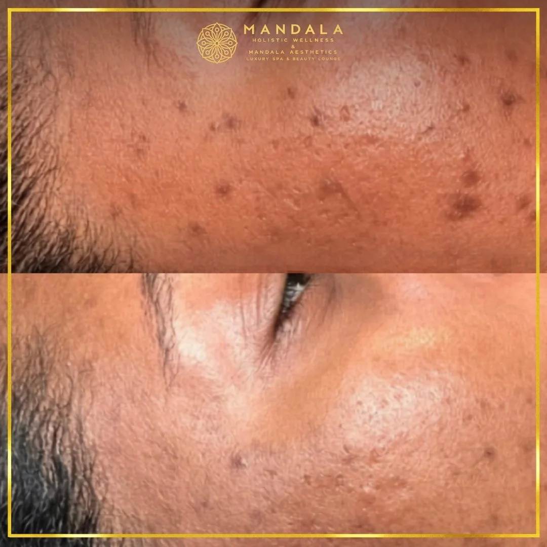 Facial treatment before and after results showing refreshed, hydrated and glowing-looking skin at Mandala Aesthetics in Preston, Melbourne.
