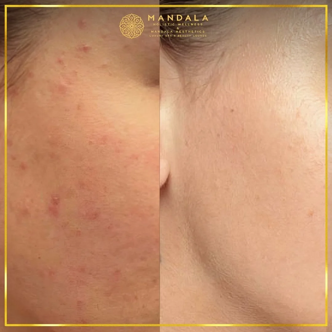Facial treatment before and after results showing refreshed, hydrated and glowing-looking skin at Mandala Aesthetics in Preston, Melbourne.