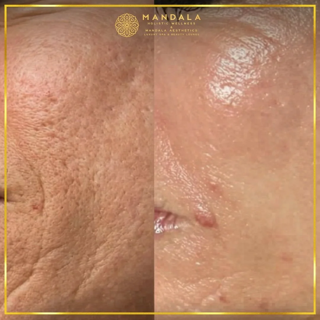 RF Microneedling before and after results showing improved-looking skin texture  and acne scars at Mandala Aesthetics in Preston, Melbourne.
