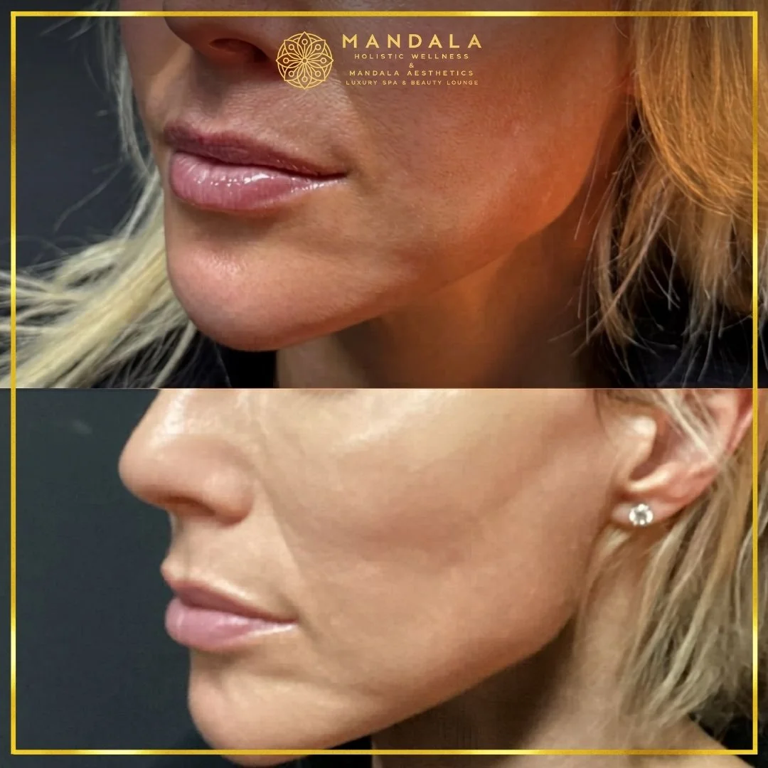 HIFU before and after results showing the lower face, chin and jawline at Mandala Aesthetics in Preston, Melbourne.