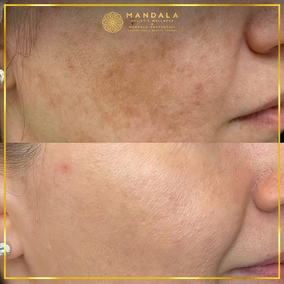 WhiteLab Spot Melanin Removal before and after results showing the appearance of age spots, sun spots , freckles, melasma, pigmentation at Mandala Aesthetics in Preston, Melbourne.