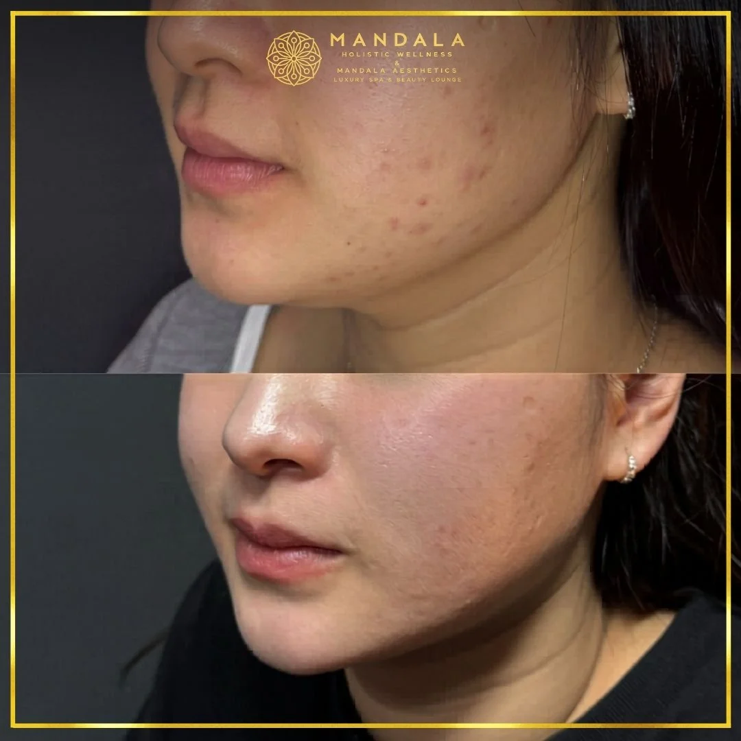 HIFU before and after results showing the lower face, chin and jawline at Mandala Aesthetics in Preston, Melbourne.