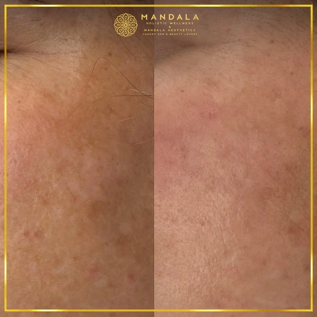 WhiteLab Spot Melanin Removal before and after results showing the appearance of age spots, sun spots , freckles, melasma, pigmentation at Mandala Aesthetics in Preston, Melbourne.
