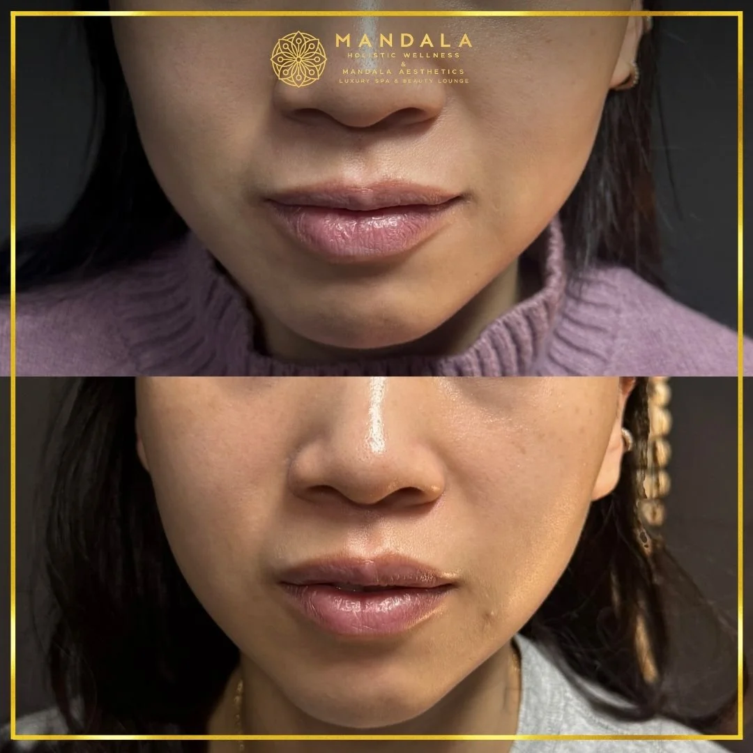 HIFU before and after results showing the lower face, chin and jawline at Mandala Aesthetics in Preston, Melbourne.