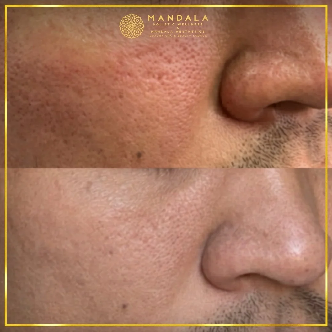 Facial treatment before and after results showing refreshed, hydrated and glowing-looking skin at Mandala Aesthetics in Preston, Melbourne.