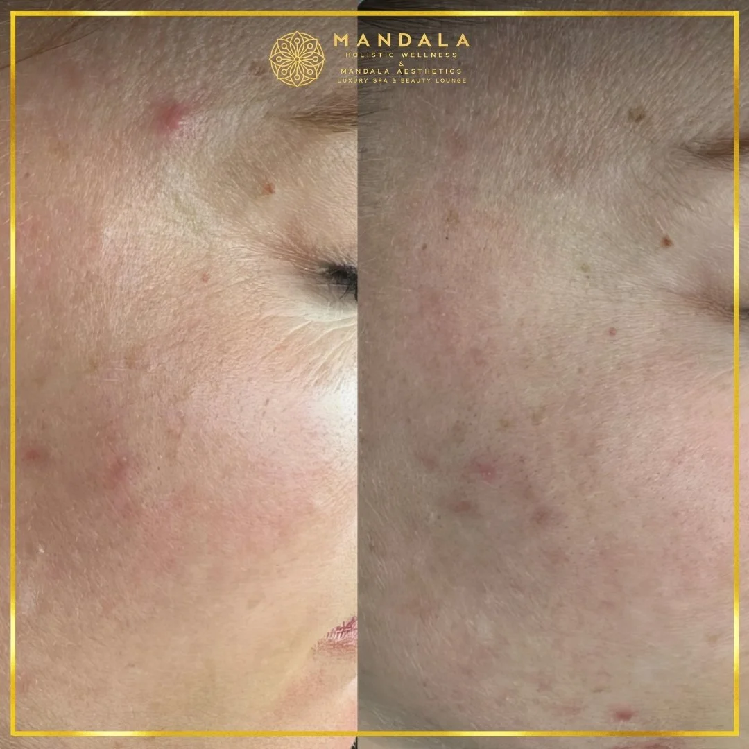 Facial treatment before and after results showing refreshed, hydrated and glowing-looking skin at Mandala Aesthetics in Preston, Melbourne.
