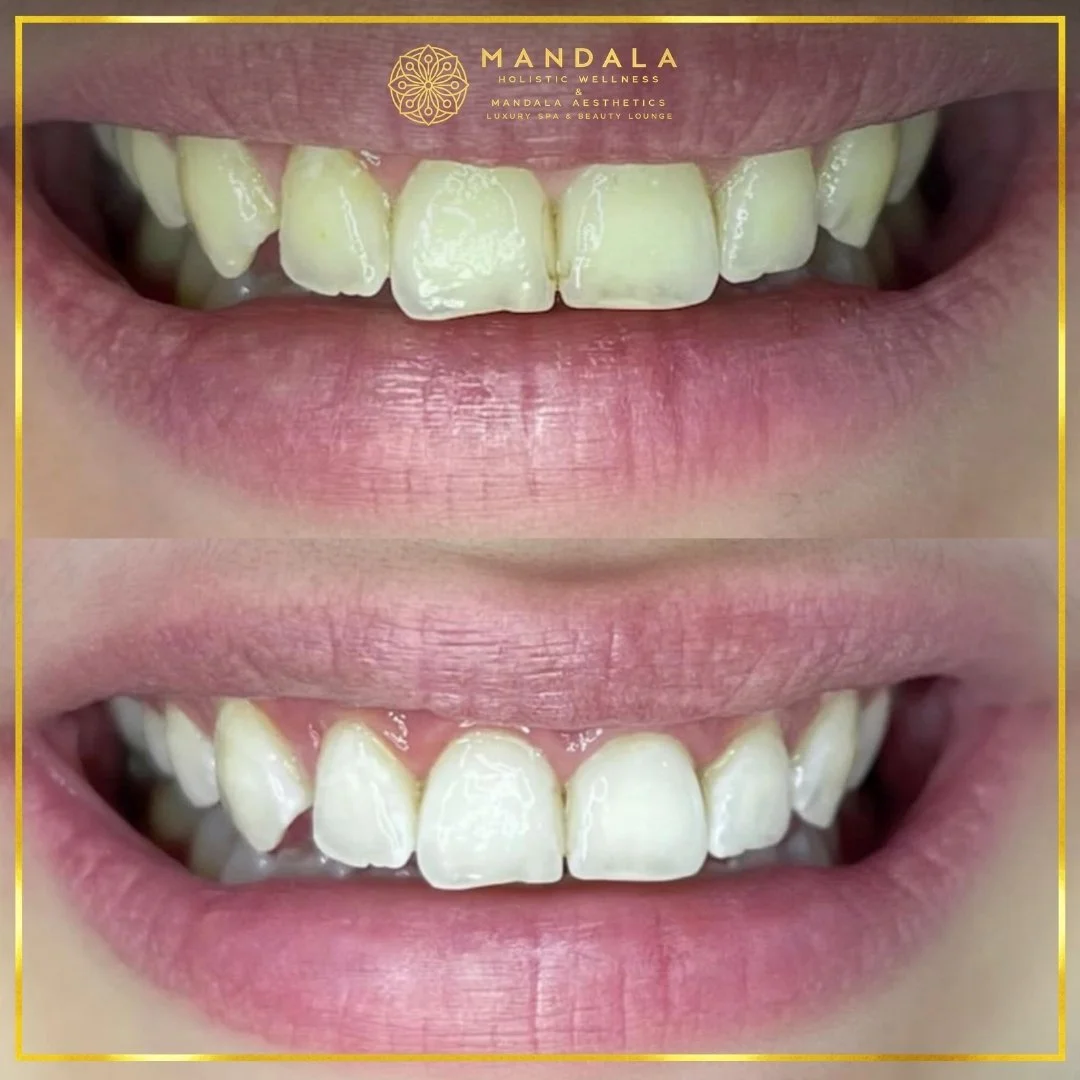 Teeth whitening before and after results showing a visibly white teeth,  brighter-looking smile at Mandala Aesthetics in Preston, Melbourne.
