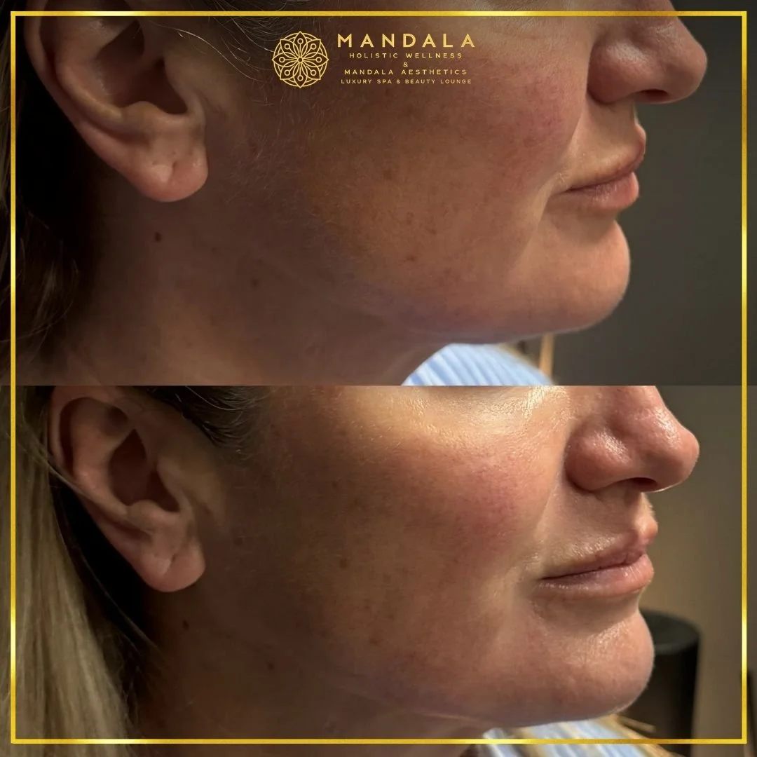 HIFU before and after results showing the lower face, chin and jawline at Mandala Aesthetics in Preston, Melbourne.