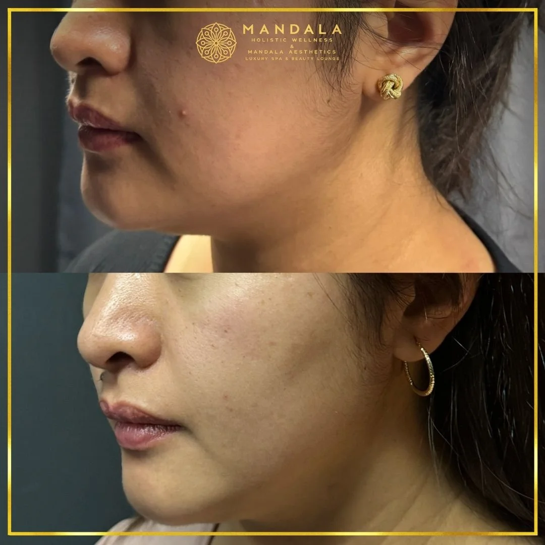 HIFU before and after results showing the lower face, chin and jawline at Mandala Aesthetics in Preston, Melbourne.