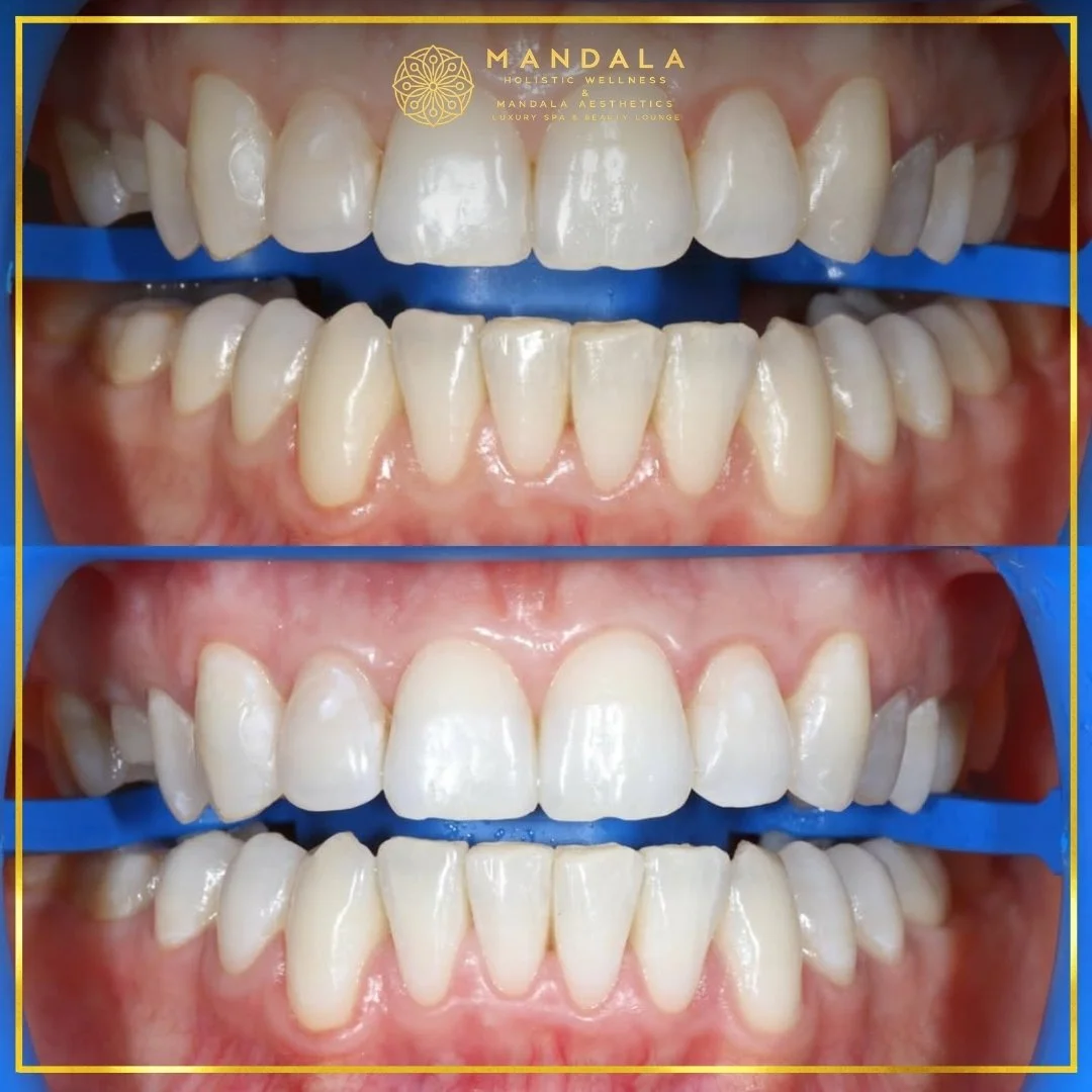 Teeth whitening before and after results showing a visibly white teeth,  brighter-looking smile at Mandala Aesthetics in Preston, Melbourne.