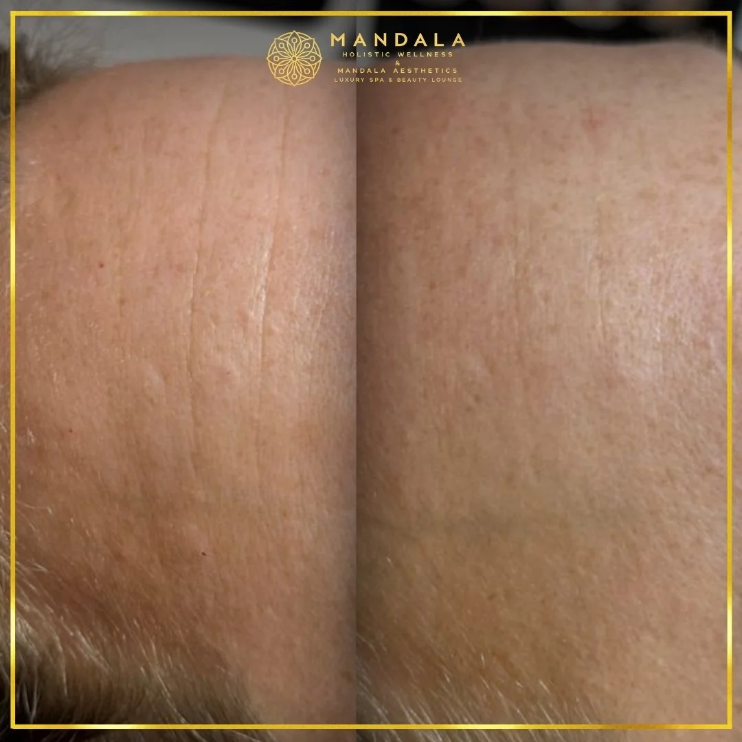 RF Microneedling before and after results showing improved-looking skin texture  and acne scars at Mandala Aesthetics in Preston, Melbourne.