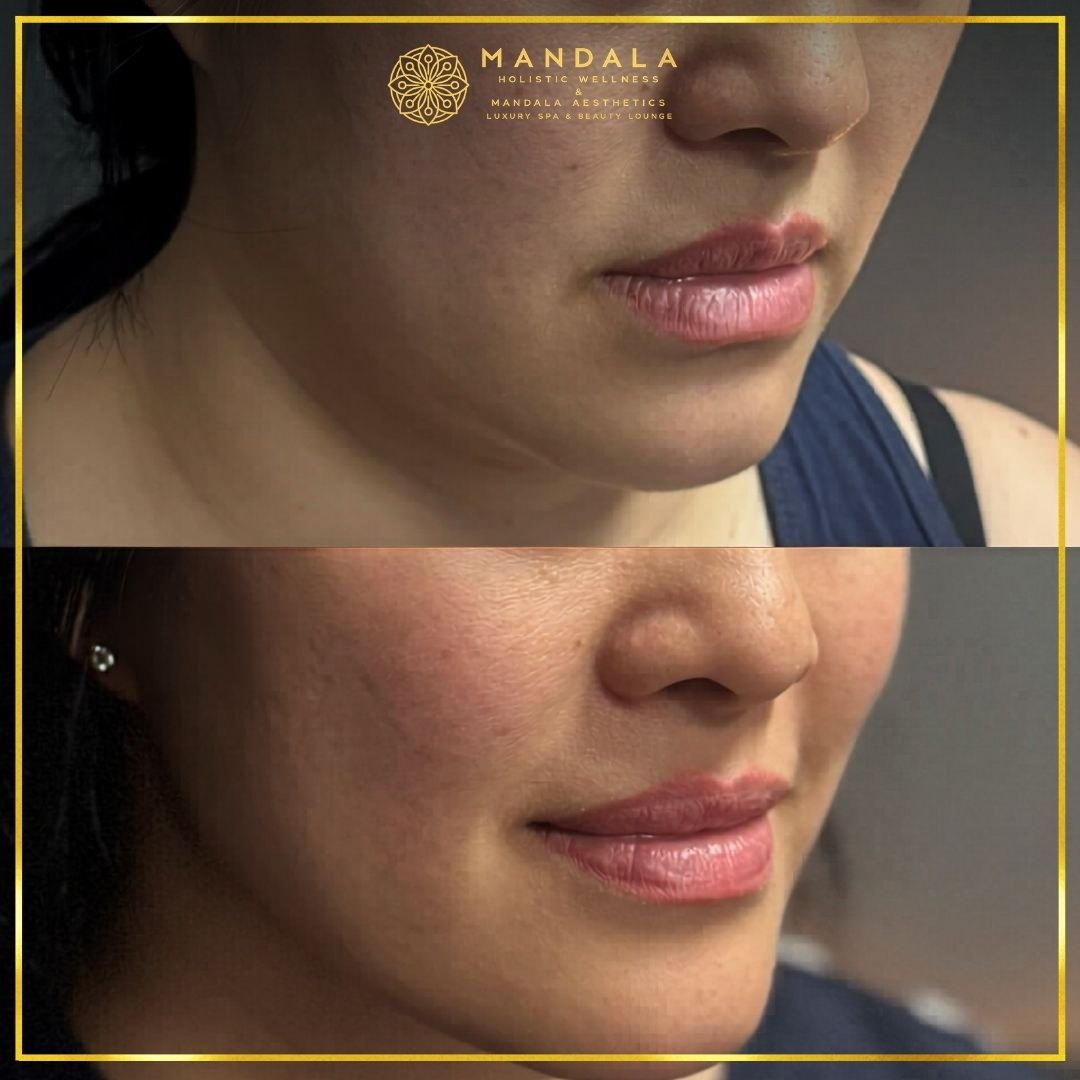 HIFU before and after results showing the lower face, chin and jawline at Mandala Aesthetics in Preston, Melbourne.