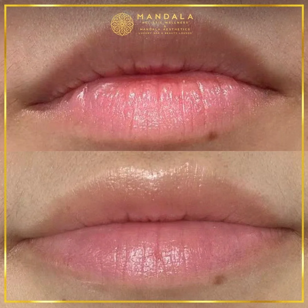 RomaPink Lip Treatment before and after results showing a more even, hydrated lips and naturally pink-looking lip tone at Mandala Aesthetics in Preston, Melbourne.