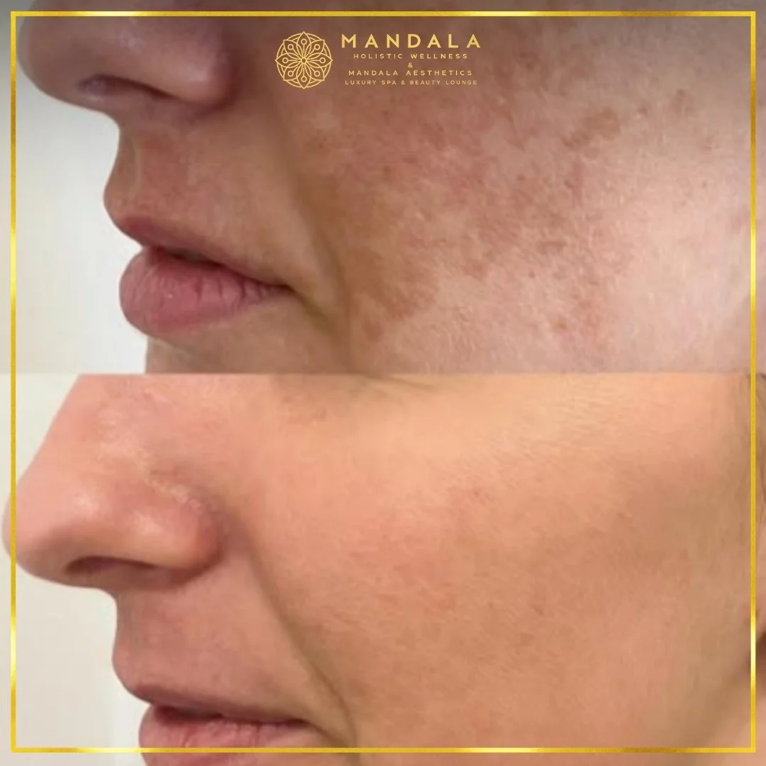 WhiteLab Spot Melanin Removal before and after results showing the appearance of age spots, sun spots , freckles, melasma, pigmentation at Mandala Aesthetics in Preston, Melbourne.
