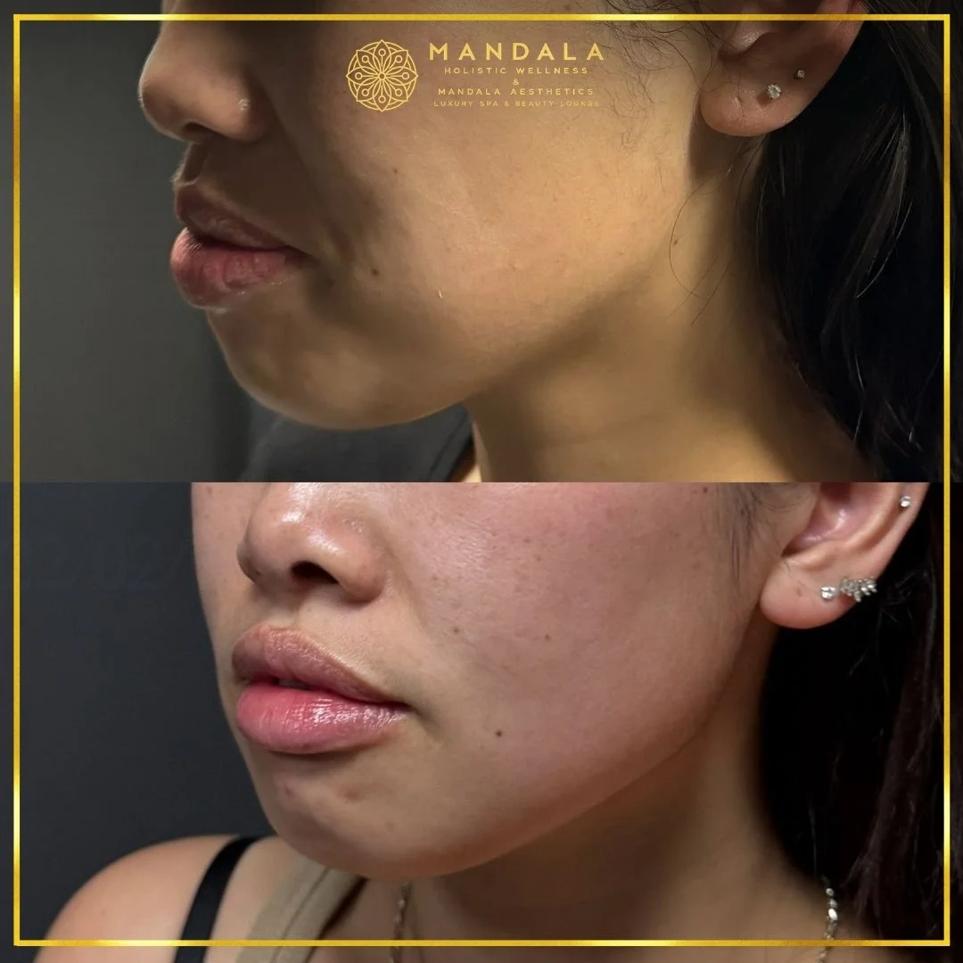 HIFU before and after results showing the lower face, chin and jawline at Mandala Aesthetics in Preston, Melbourne.