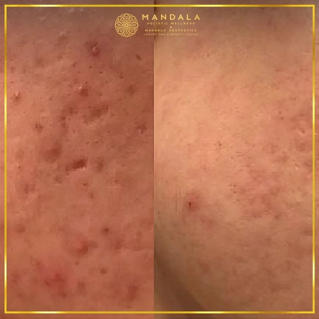 RF Microneedling before and after results showing improved-looking skin texture  and acne scars at Mandala Aesthetics in Preston, Melbourne.