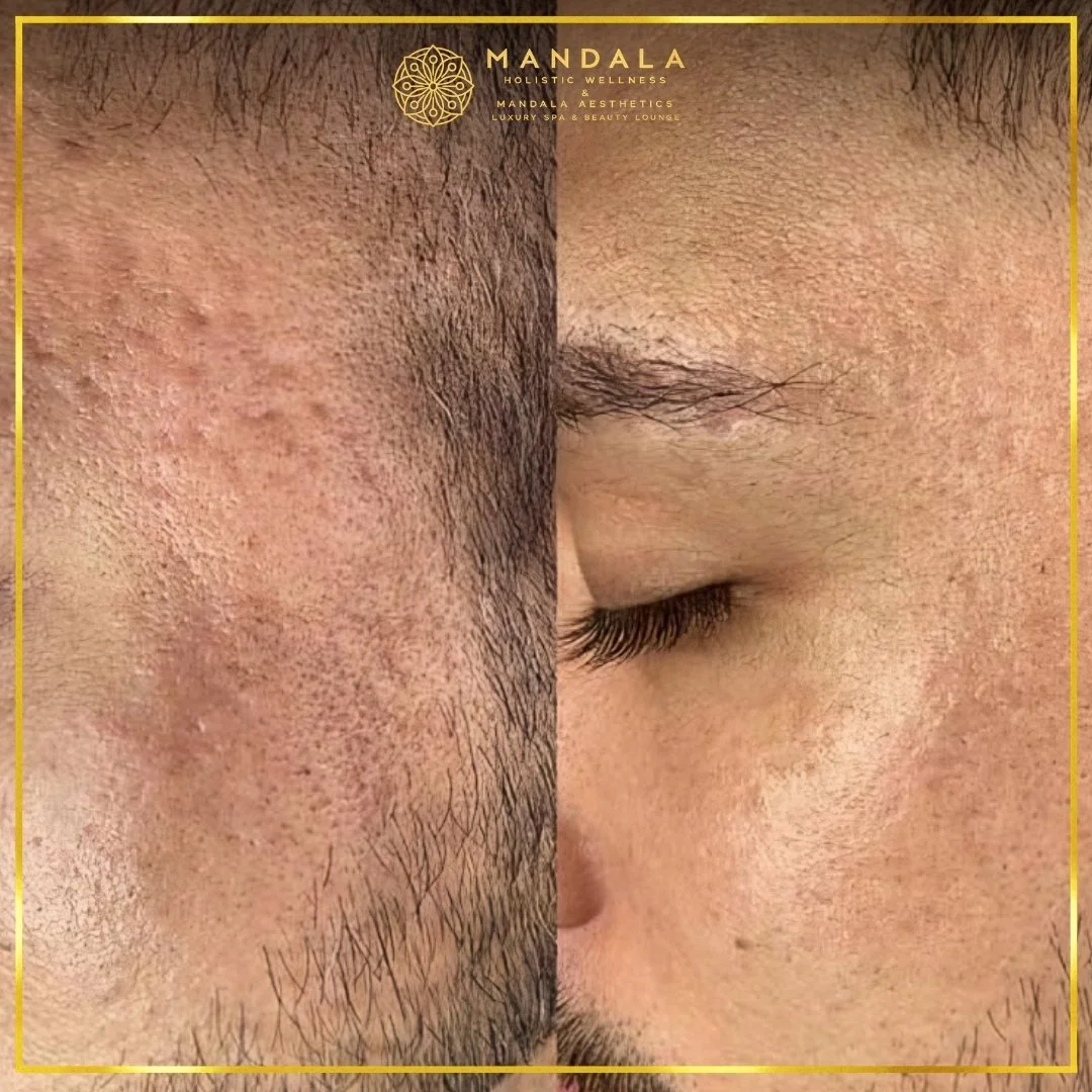RF Microneedling before and after results showing improved-looking skin texture  and acne scars at Mandala Aesthetics in Preston, Melbourne.