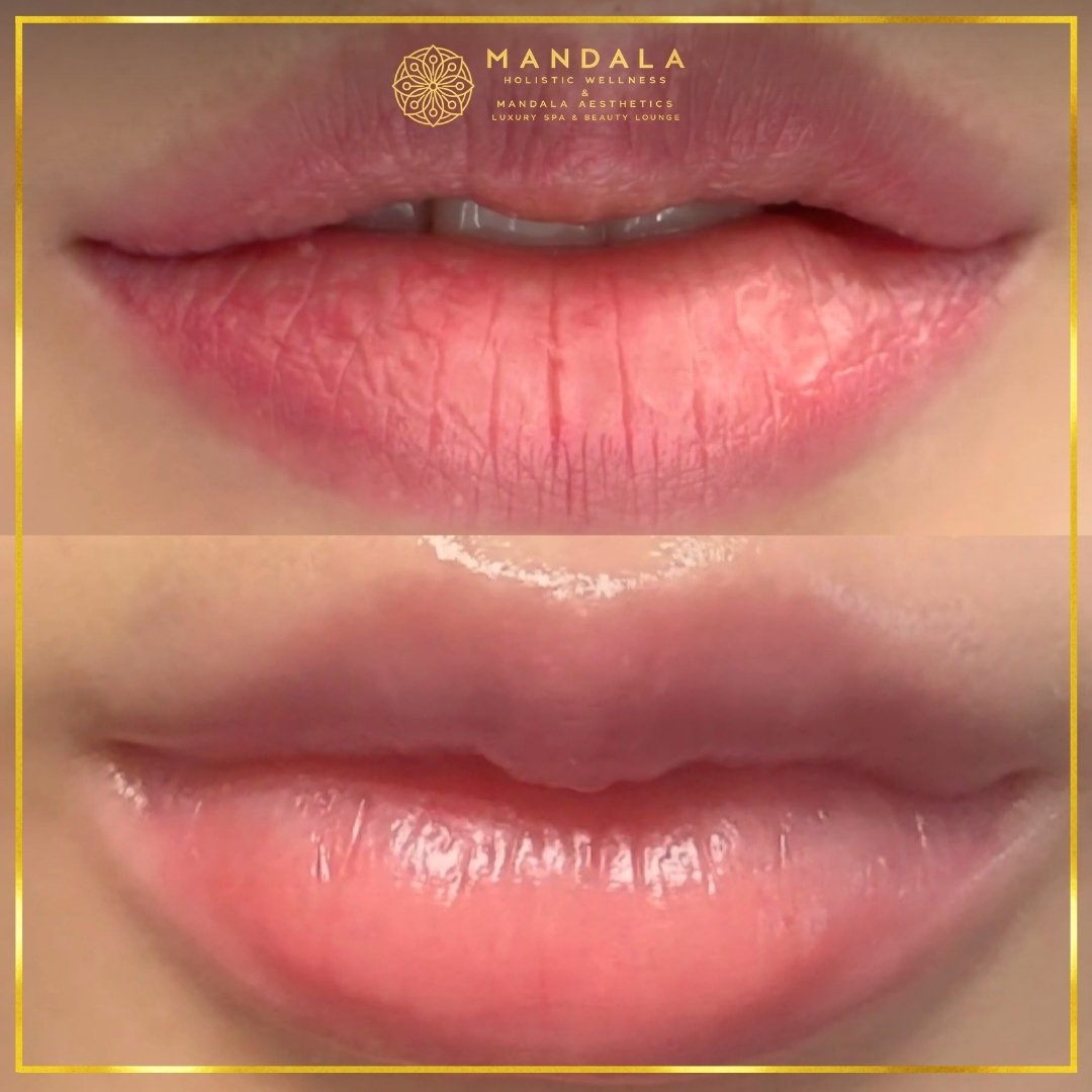 RomaPink Lip Treatment before and after results showing a more even, hydrated lips and naturally pink-looking lip tone at Mandala Aesthetics in Preston, Melbourne.