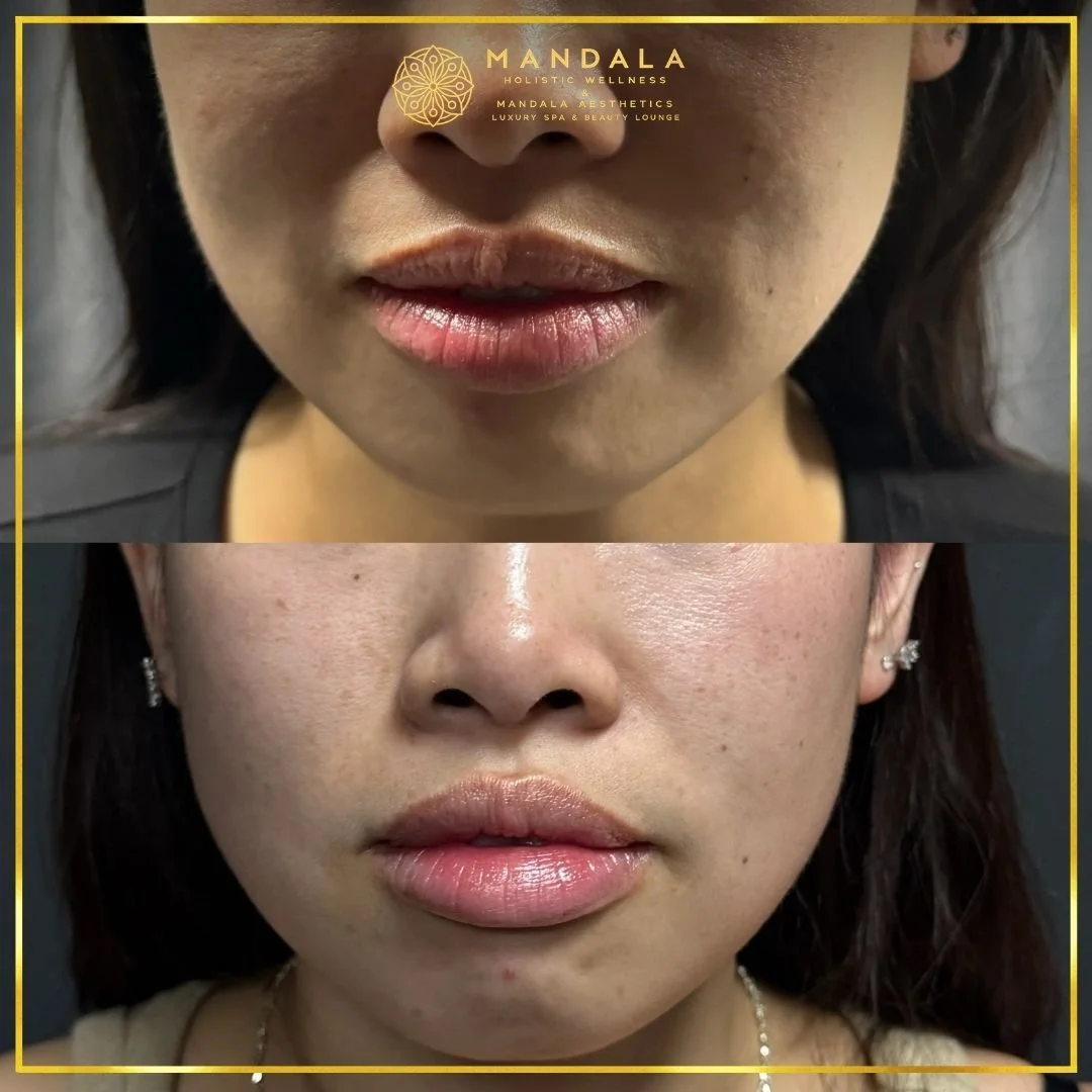 HIFU before and after results showing the lower face, chin and jawline at Mandala Aesthetics in Preston, Melbourne.