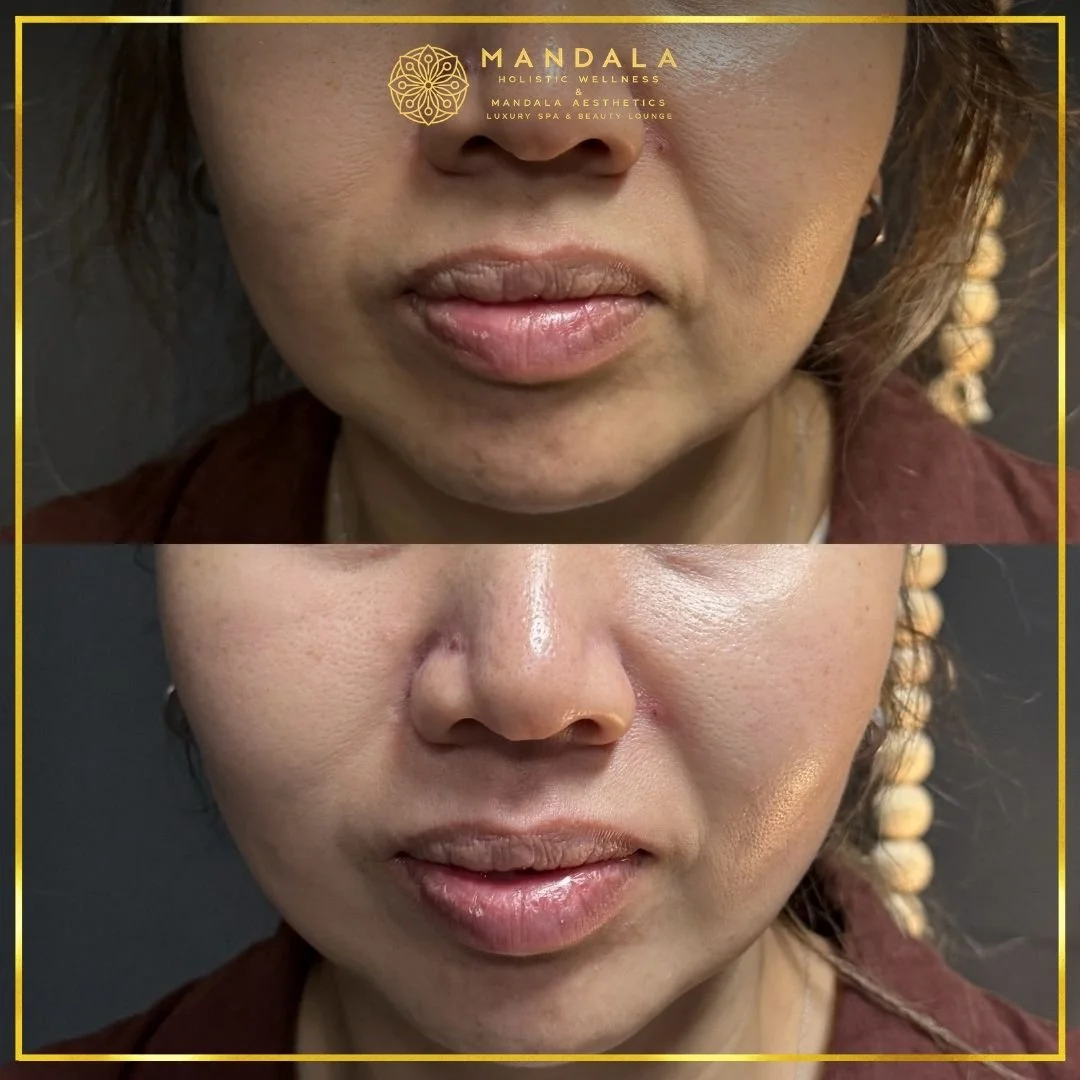 HIFU before and after results showing the lower face, chin and jawline at Mandala Aesthetics in Preston, Melbourne.