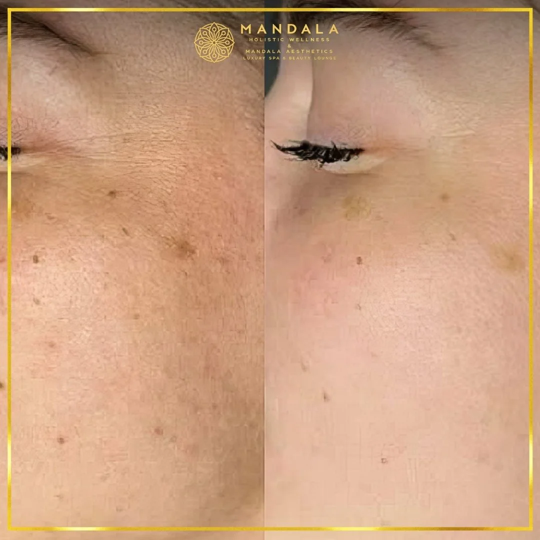 RF Microneedling before and after results showing improved-looking skin texture  and acne scars at Mandala Aesthetics in Preston, Melbourne.