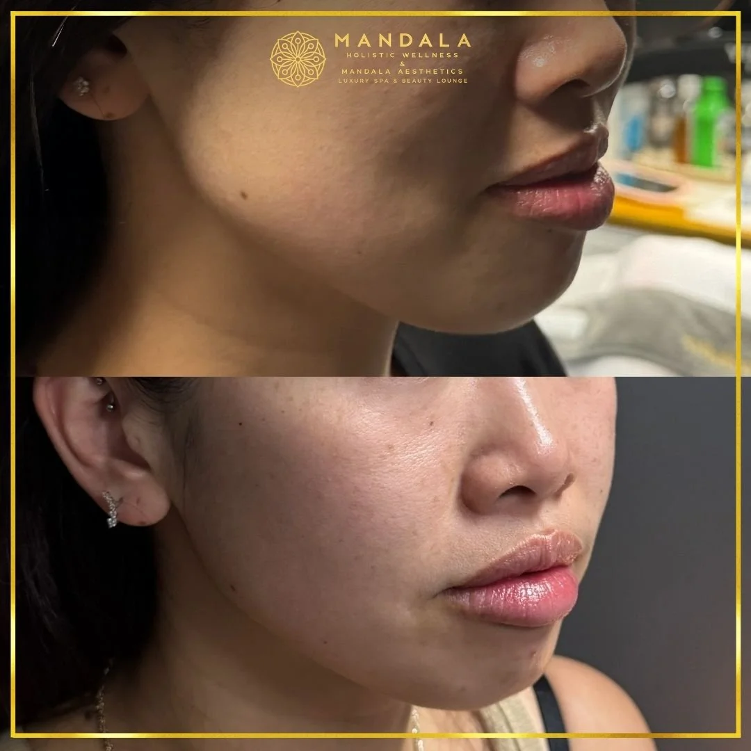 HIFU before and after results showing the lower face, chin and jawline at Mandala Aesthetics in Preston, Melbourne.