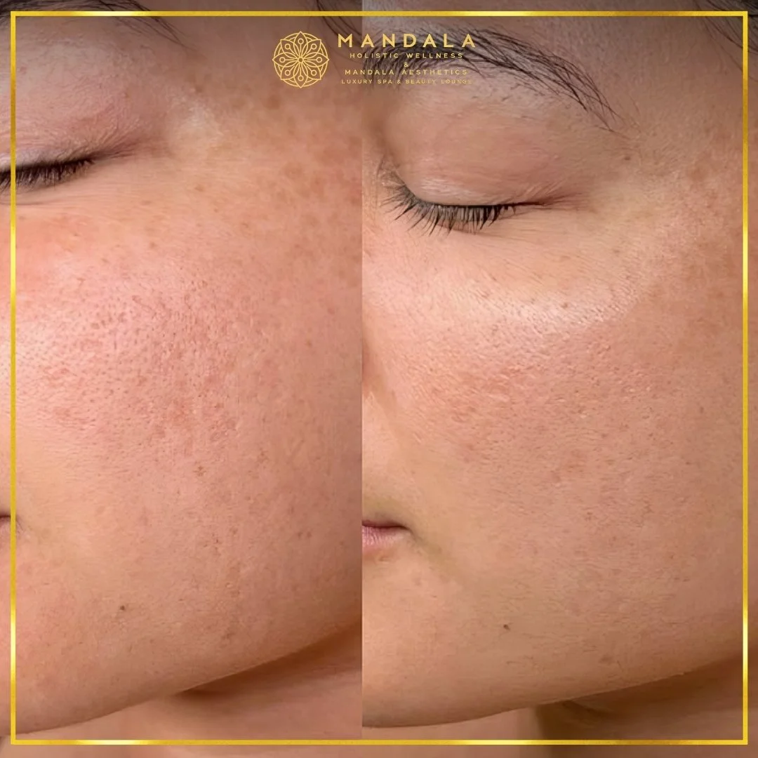 RF Microneedling before and after results showing improved-looking skin texture  and acne scars at Mandala Aesthetics in Preston, Melbourne.