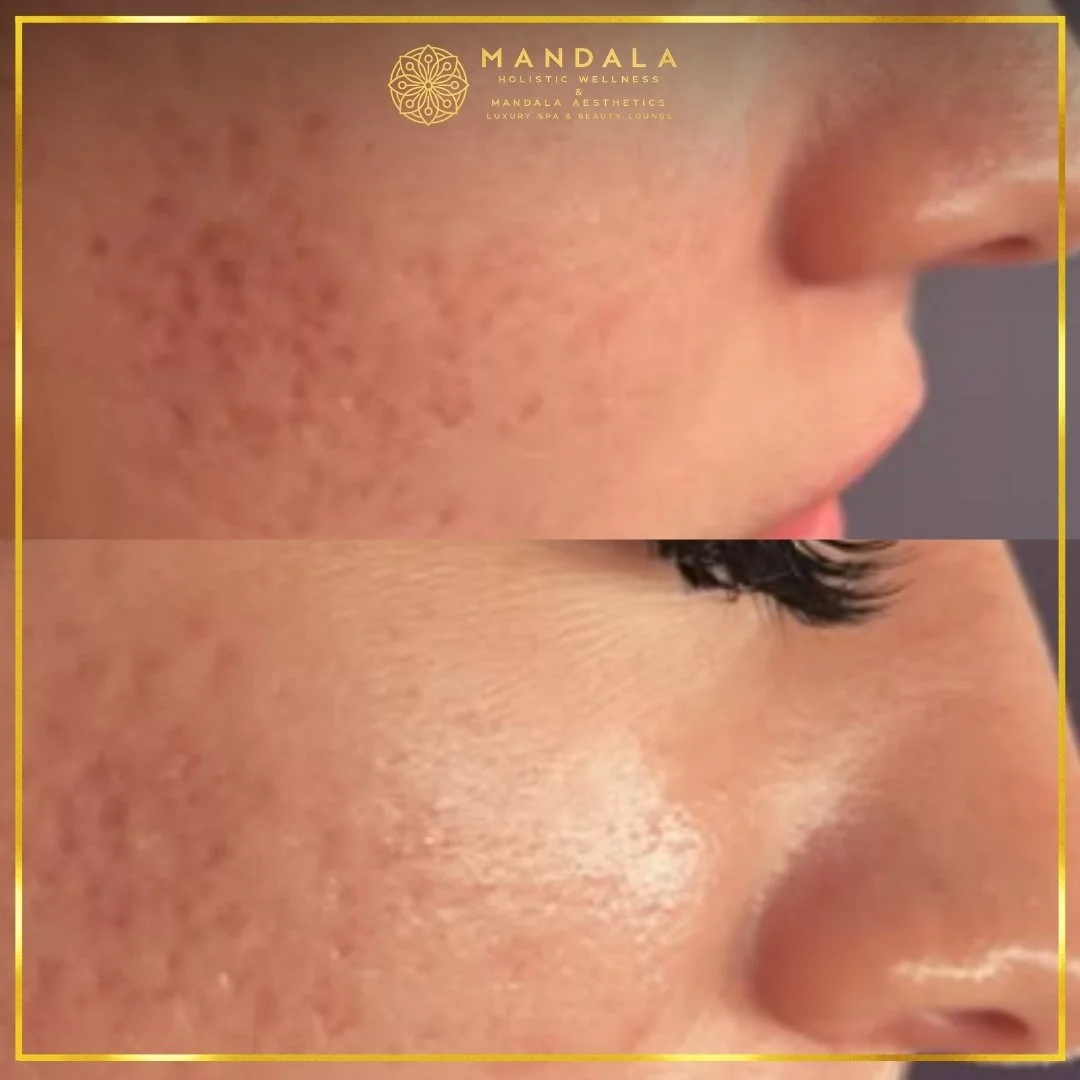 Facial treatment before and after results showing refreshed, hydrated and glowing-looking skin at Mandala Aesthetics in Preston, Melbourne.