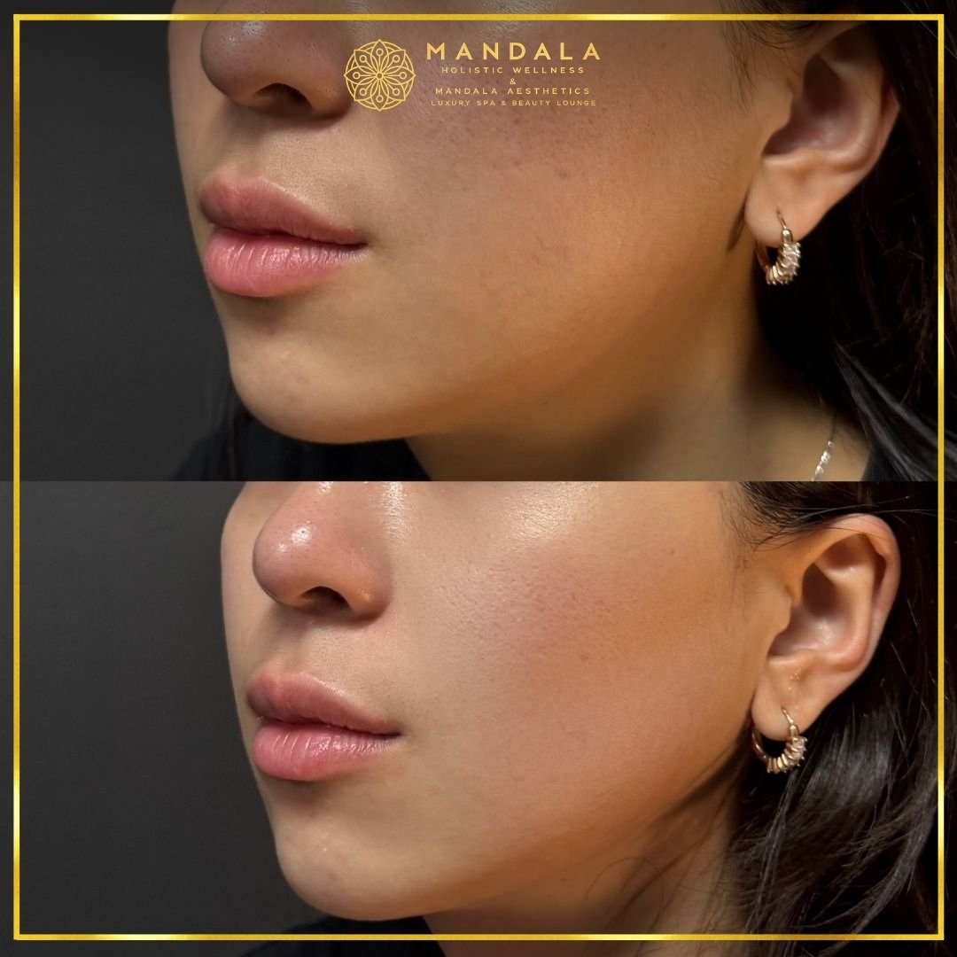 HIFU before and after results showing the lower face, chin and jawline at Mandala Aesthetics in Preston, Melbourne.