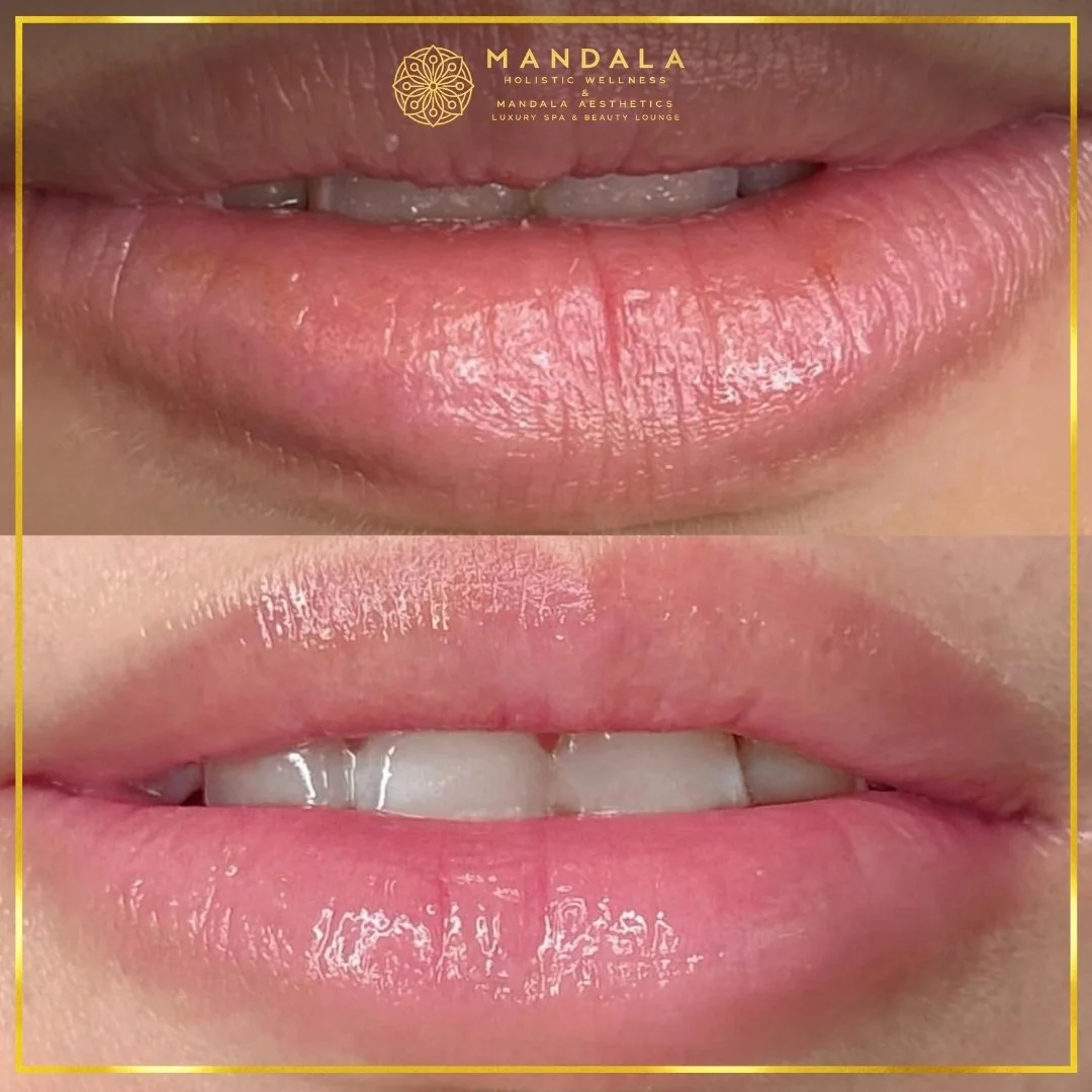 RomaPink Lip Treatment before and after results showing a more even, hydrated lips and naturally pink-looking lip tone at Mandala Aesthetics in Preston, Melbourne.