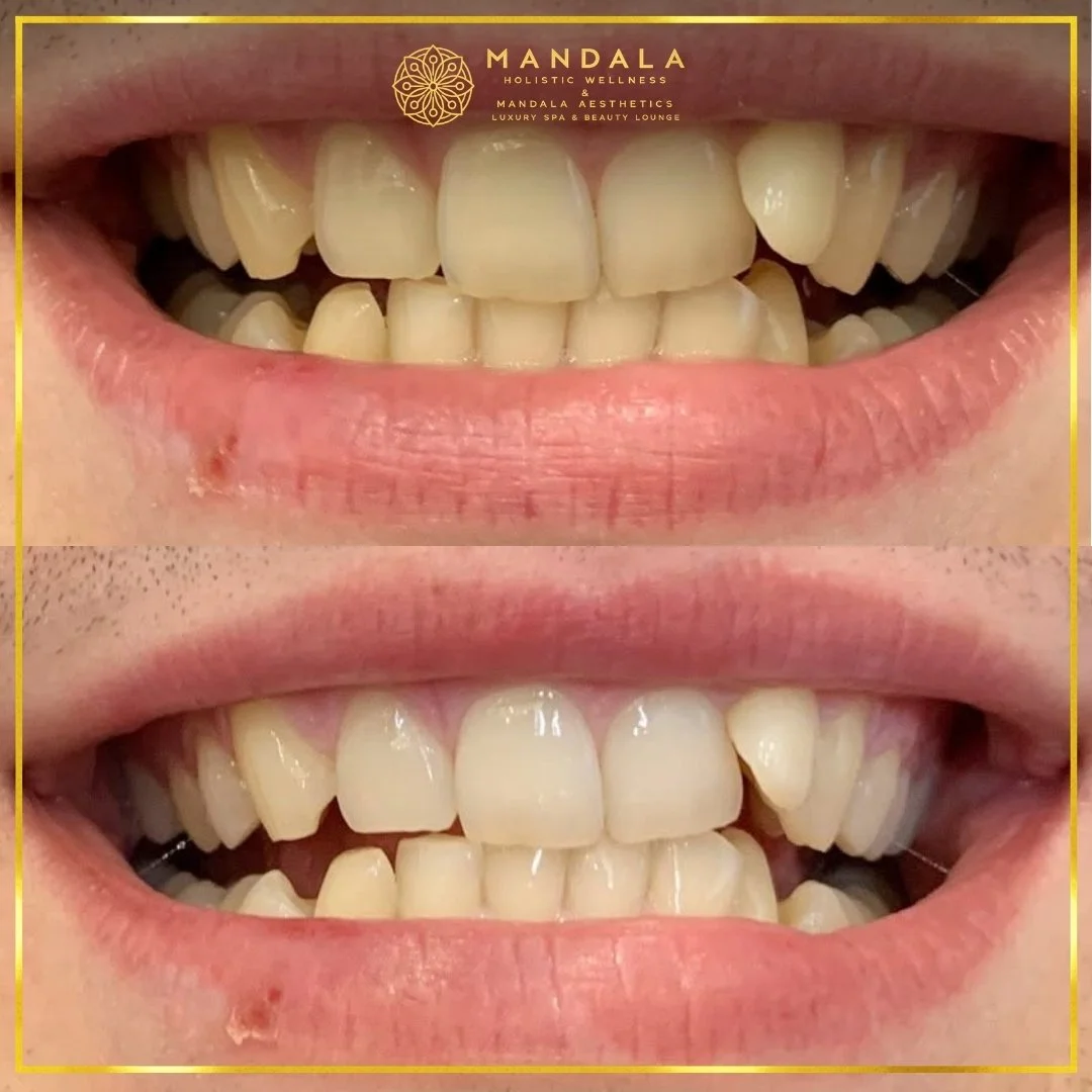Teeth whitening before and after results showing a visibly white teeth,  brighter-looking smile at Mandala Aesthetics in Preston, Melbourne.