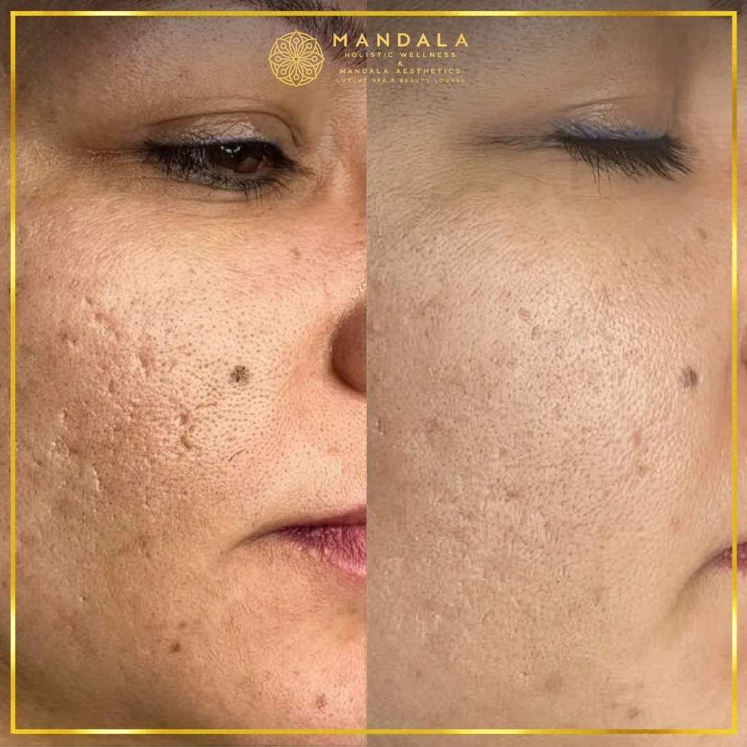 RF Microneedling before and after results showing improved-looking skin texture  and acne scars at Mandala Aesthetics in Preston, Melbourne.