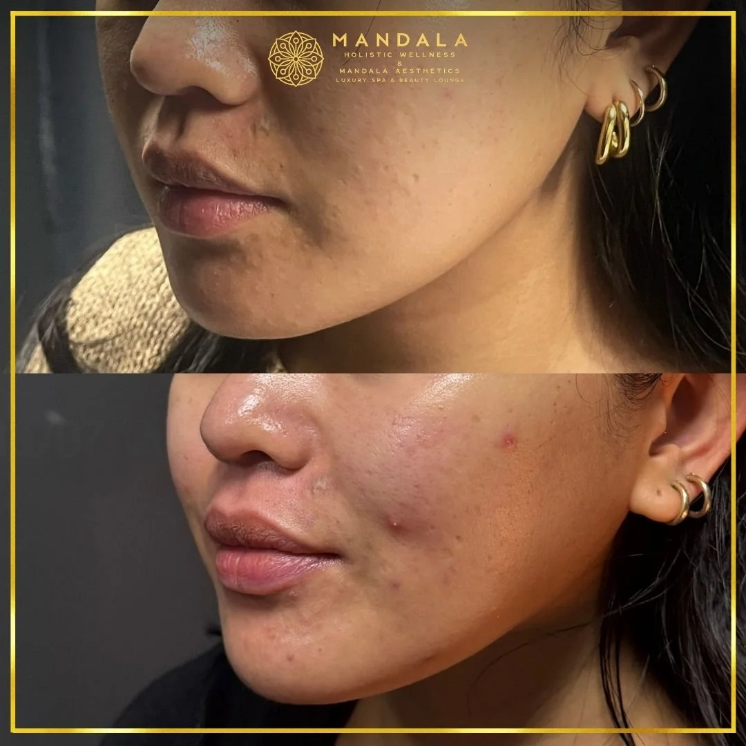 HIFU before and after results showing the lower face, chin and jawline at Mandala Aesthetics in Preston, Melbourne.
