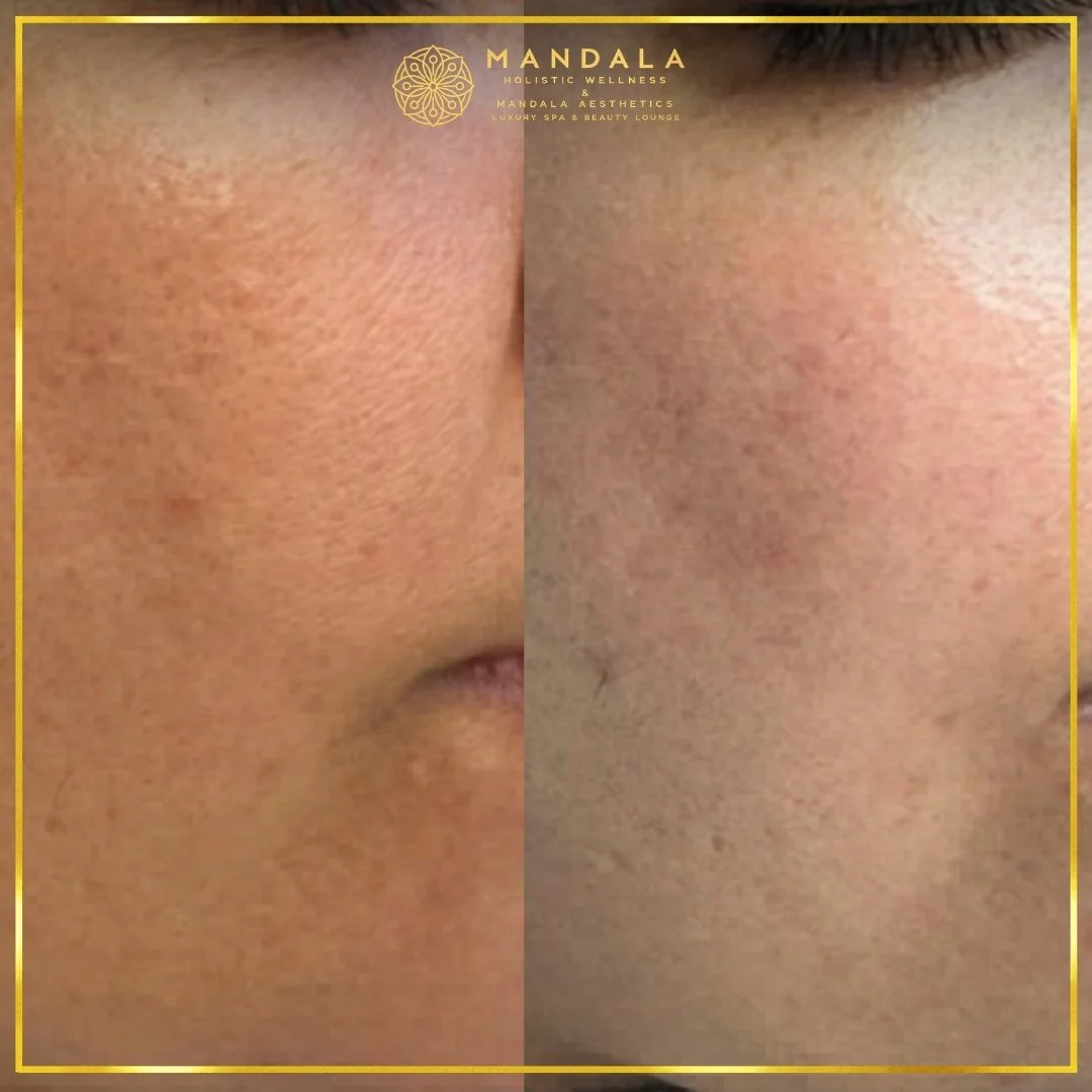 Facial treatment before and after results showing refreshed, hydrated and glowing-looking skin at Mandala Aesthetics in Preston, Melbourne.