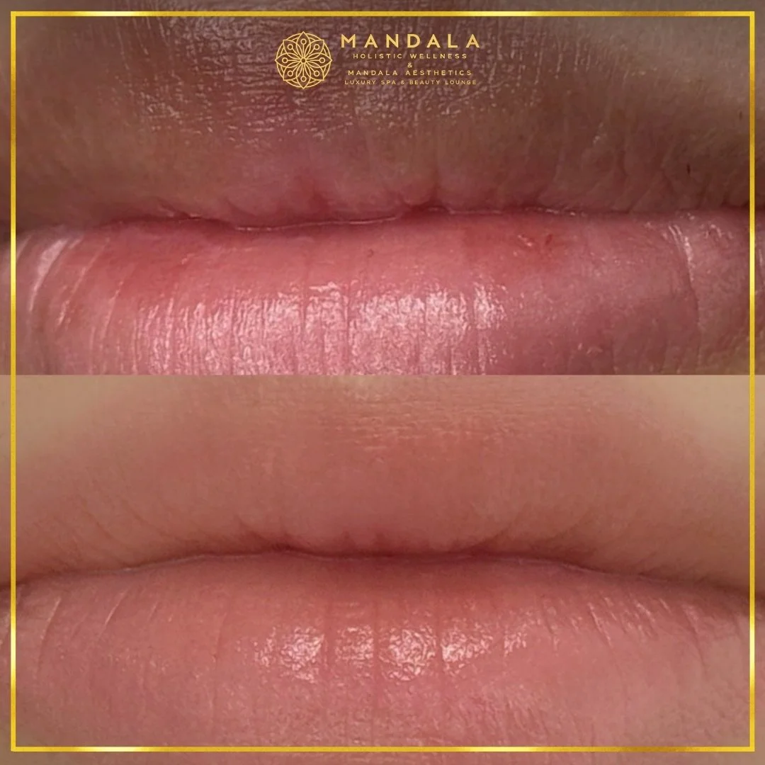 RomaPink Lip Treatment before and after results showing a more even, hydrated lips and naturally pink-looking lip tone at Mandala Aesthetics in Preston, Melbourne.